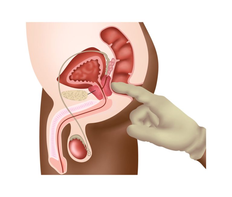 Diagnóstico do câncer de próstata: Dr. Marco Túlio Cruvinel, urologista em Goiânia, explica quais são as etapas essenciais para a detecção precoce