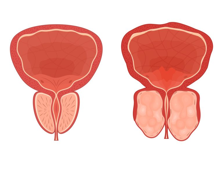 HoLEP e Rezum disputam espaço como melhor cirurgia para próstata em 2025