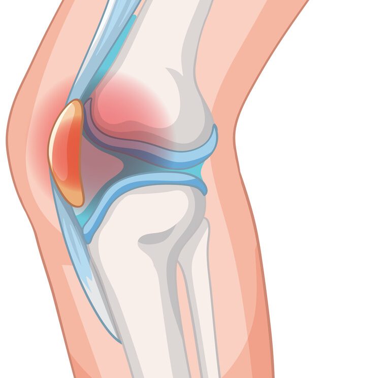 Dor na frente do joelho Pode ser condropatia patelar