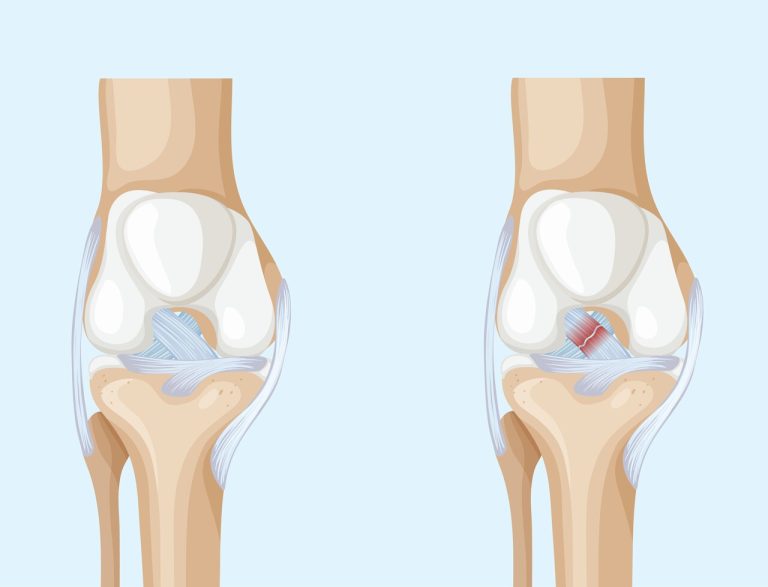 Dor súbita no joelho pode indicar lesão do LCA
