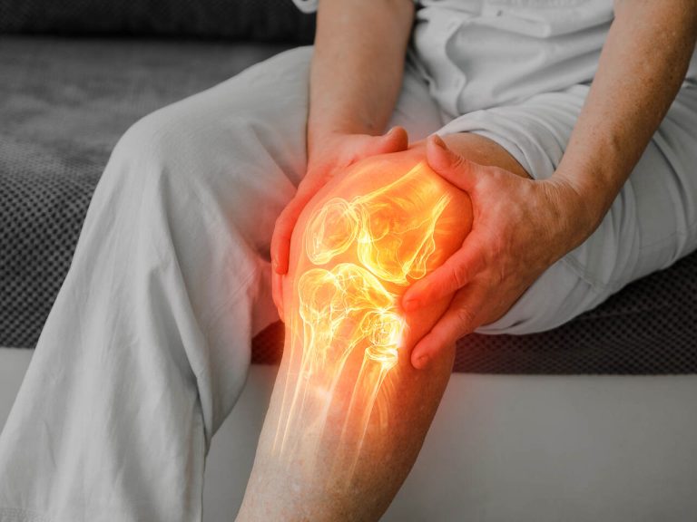 Artrose avançada no joelho pode exigir tratamento cirúrgico